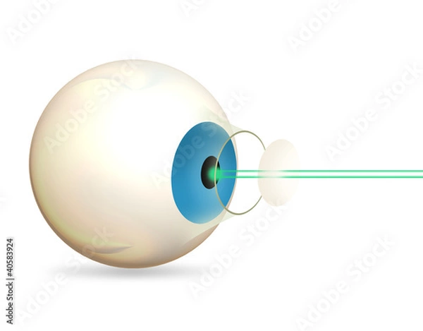 Fototapeta Laser Eye Surgery