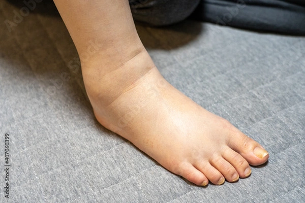 Fototapeta むくみ　女性の足