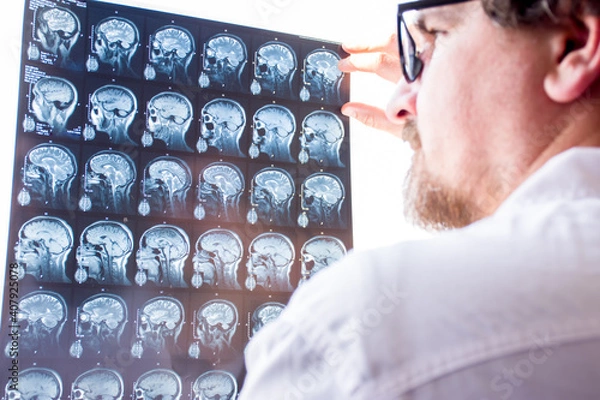 Fototapeta Doctors evaluation results of magnetic resonance imaging of brain in hospital concept photo. Neurologist in glasses keeps hand on glass of negatoscope MRI scan and examines structure of brain tissue 