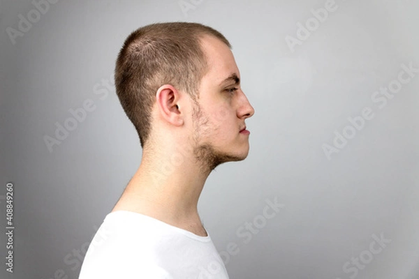 Fototapeta Malocclusion, man in profile. Wrong bite: lower jaw extended forward and retracted. Bite correction with braces. Young man in profile
