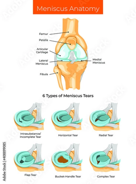 Fototapeta Vector illustration. Meniscus Anatomy and 6 Types of Meniscus Tears.