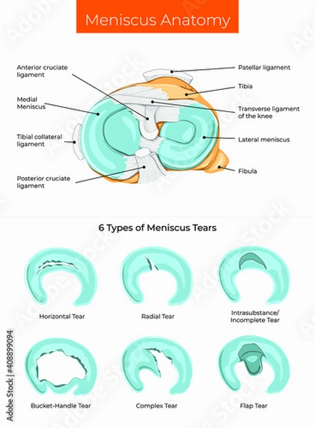Fototapeta Vector illustration. Meniscus Anatomy and 6 Types of Meniscus Tears.