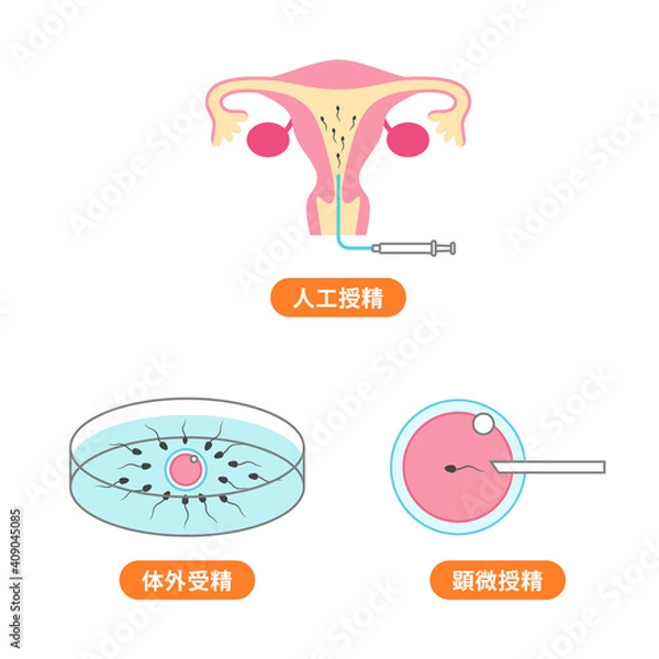 Obraz 人工授精、体外受精、顕微授精のイラスト
