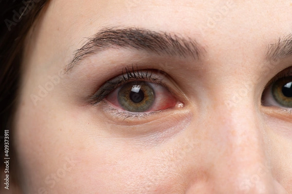 Fototapeta Macro of a girl's red eye, allergy triggered conjunctivitis concept