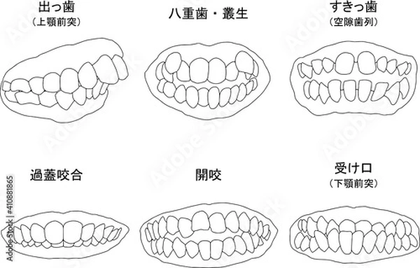 Obraz 歯列矯正治療の対象になる代表的な症例線画セット（塗りなし）