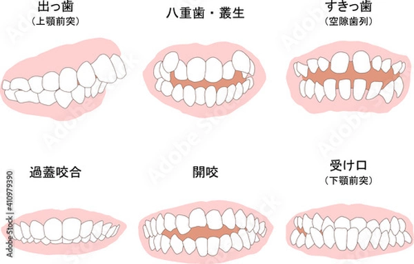 Obraz 歯列矯正治療の対象になる代表的な症例セット　ベタ塗り線あり