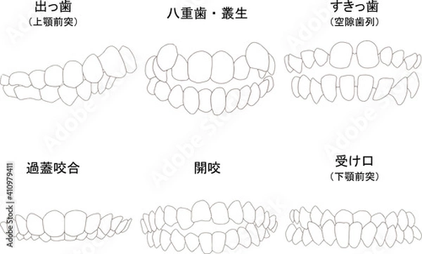 Obraz 歯列矯正治療の対象になる代表的な症例セット（歯のみ）　ベタ塗り線あり