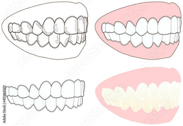 Obraz 正しい歯並びに透明なマウスピースを付けた横向きセット
