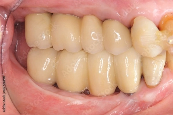 Obraz インプラント治療