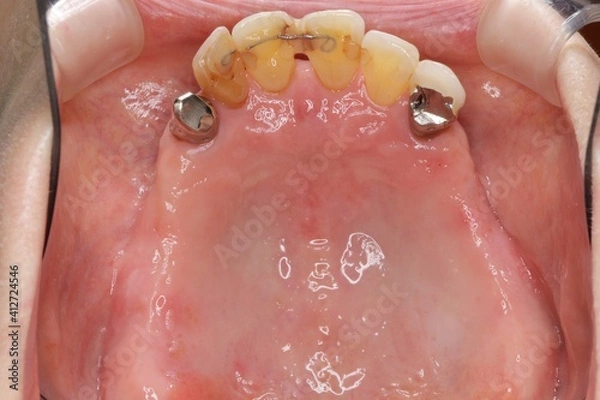 Fototapeta 歯の喪失　入れ歯