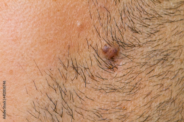 Fototapeta man stub with wart