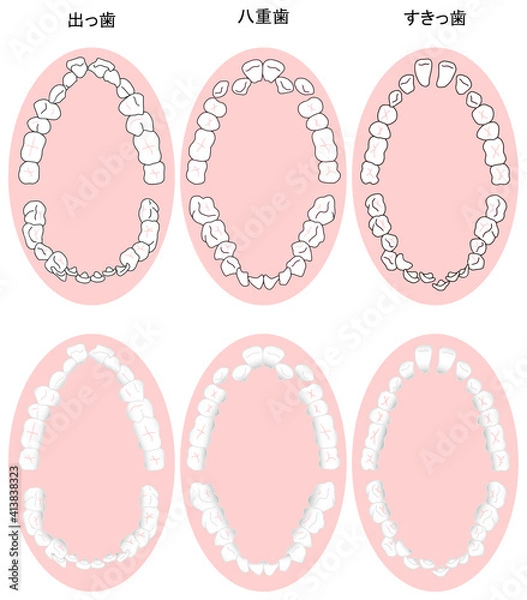 Obraz 歯列矯正治療の対象になる代表的な症例を上から見た図セット　カラー