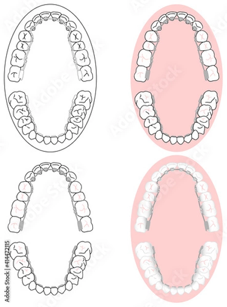 Obraz 正しい歯並びに矯正治療の裏側矯正のメタルブラケット装着セット