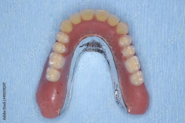 Obraz 金属床義歯　入れ歯