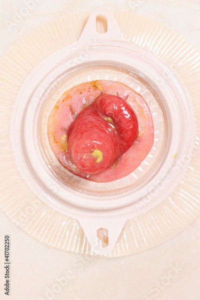 Obraz Colostomy