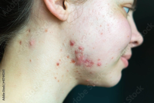 Obraz Pimples on the skin of a young girl close-up. Acne on the face of a teenage girl. Problems and treatment of acne in young people. Skin rashes, allergies. Keloids. The medical concept is puberty.