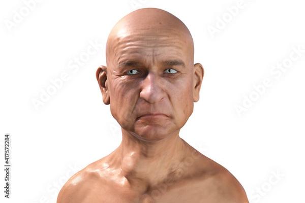 Fototapeta Thyroid cancer, tumor inside thyroid gland