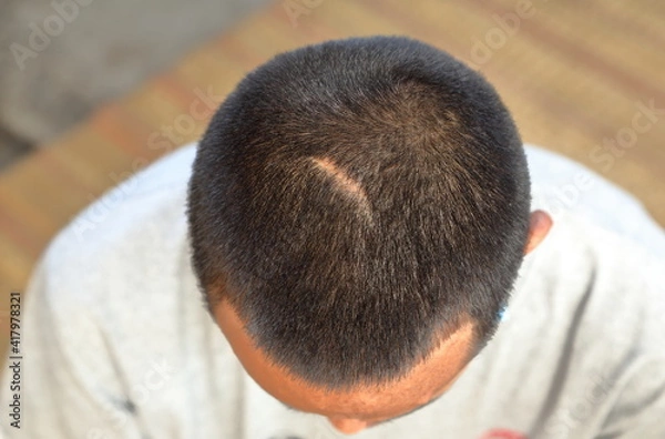 Obraz Small scars on the head