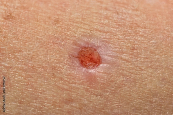 Obraz Hautwunde nach Gewebe Biopsie