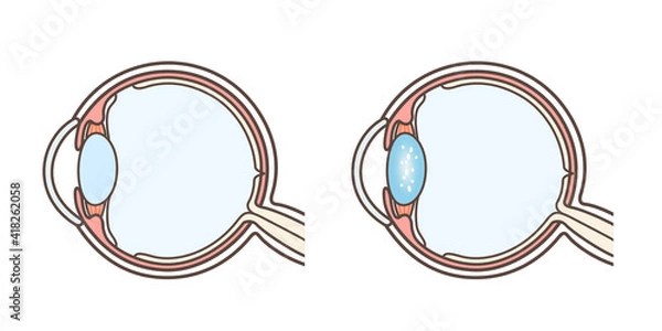 Obraz 白内障の説明の図解