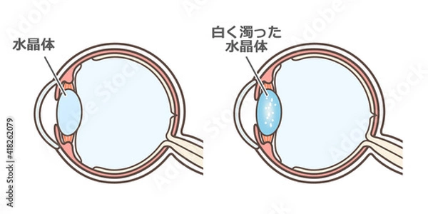 Fototapeta 白内障の説明の図解