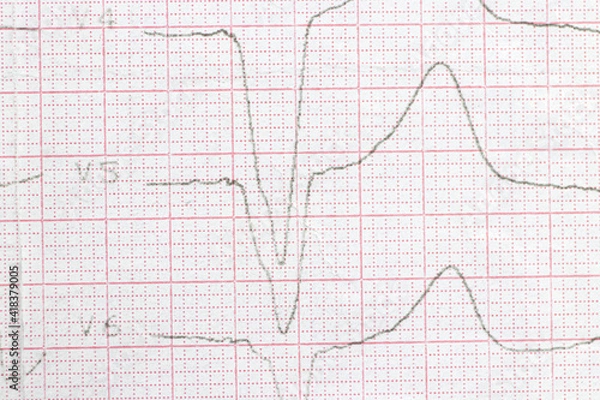 Fototapeta Macro photo of ECG cardiogram of a patient with a heart attack.
