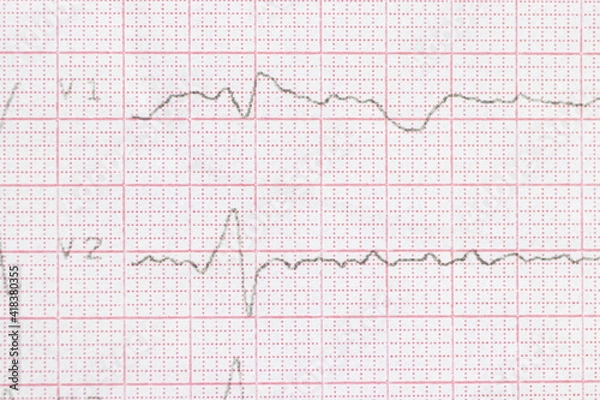Fototapeta Macro or close-up ECG cardiogram of a patient with left bundle branch block. Diagnosis and treatment of heart disease