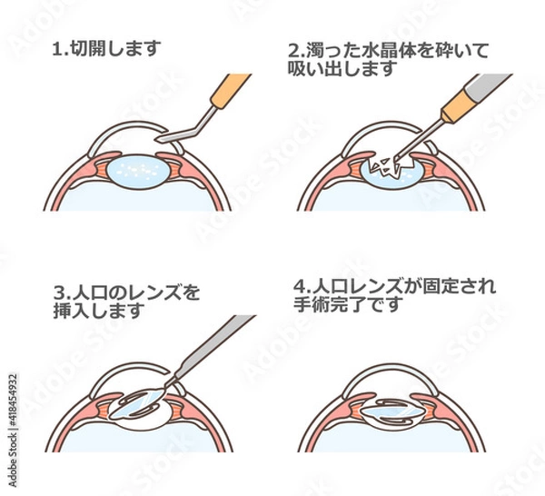 Fototapeta 白内障手術の図解