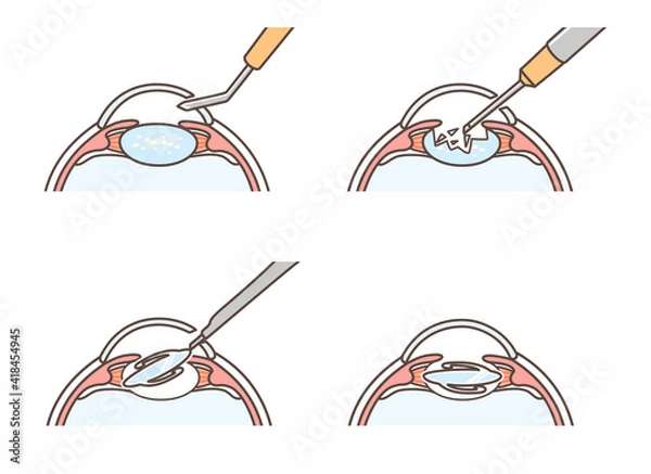 Fototapeta 白内障手術の図解