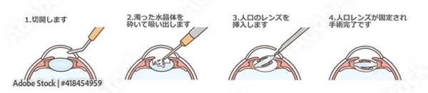 Obraz 白内障手術の図解