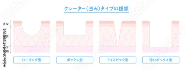 Fototapeta クレータータイプのニキビ跡の種類と肌断面図のイラスト