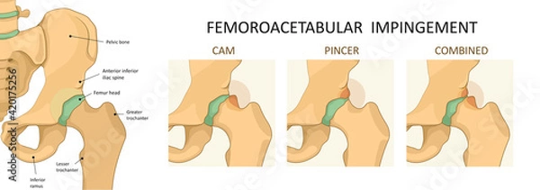 Fototapeta Femoroacetabular impingement (FAI). Front view of hip joint with section of the pelvis. Human skeleton, medicine.