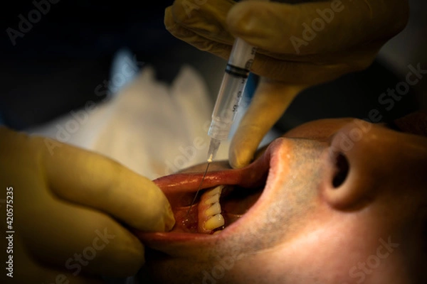 Obraz Close up dentist teeth operation 