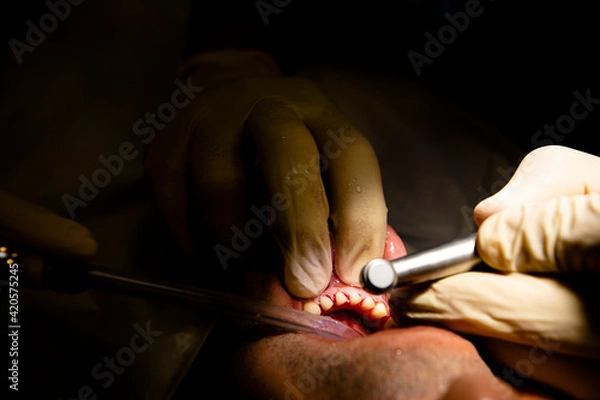 Obraz Close up dentist teeth operation 