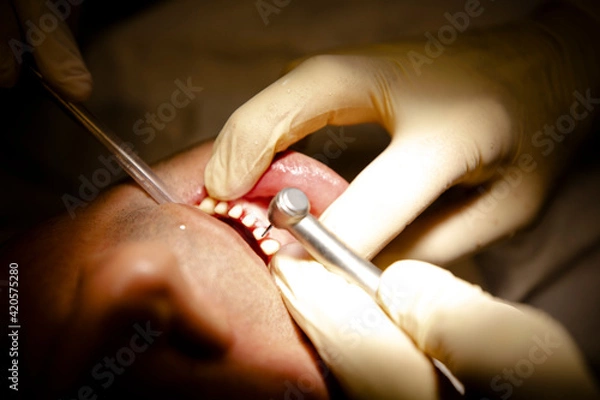 Obraz Close up dentist teeth operation 