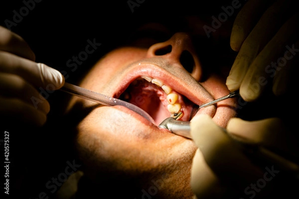 Obraz Close up dentist teeth operation 