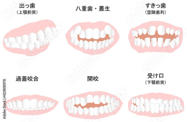 Obraz 歯列矯正治療の対象になる代表的な症例セット　塗りのみ線なし
