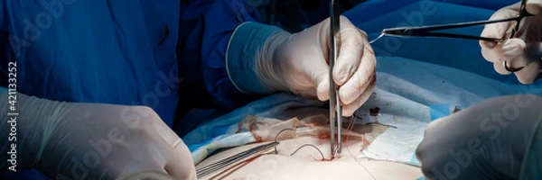 Fototapeta Doctors in blue uniforms use medical instruments and metal thread to suture human skin during surgery. Close-up hands in sterile gloves, covered with blood. Wide format.