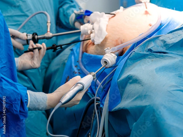 Fototapeta A surgeon in latex gloves and a blue uniform holds special medical instruments during a laparoscopic minimally invasive operation. Treatment of proctological diseases.