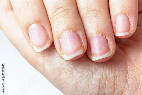 Fototapeta Close up on a female hands with dry skin and hangnails. Long fingernails and cuticles in bad condition. Chapped and neglected hands. Hands care concept. Lack of manicure in a lady fingers.
