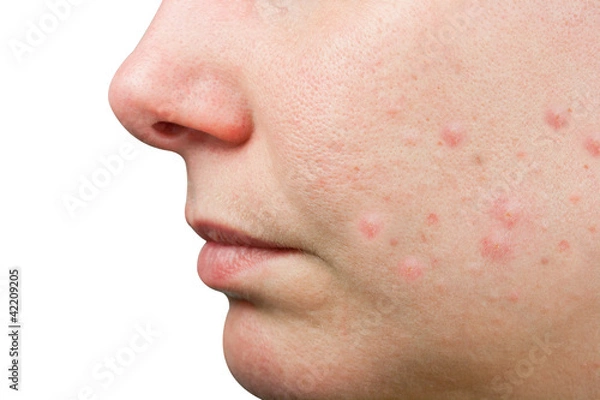 Fototapeta Akne