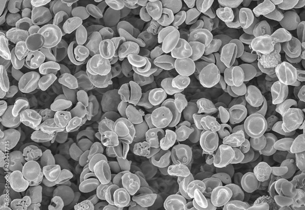 Fototapeta Scanning electron microgram of a blood sample taken from a Plasmodium (malaria parasite) infected subject. Normal red blood cells alternate with infected and dysmorphic cells that show irregularities