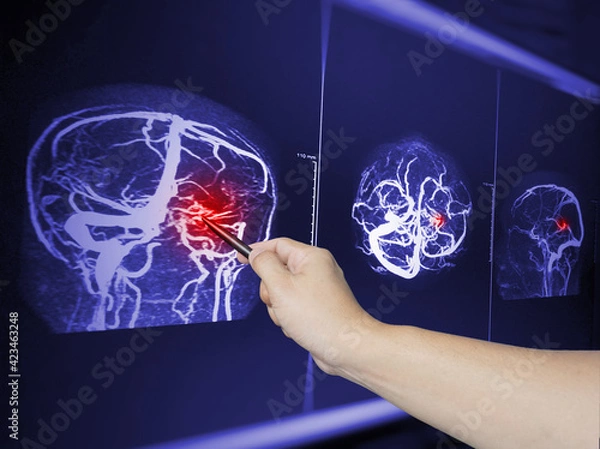 Obraz Close up Hand doctor point MRA brian scan image of a recent traumatic brain injury patient showing brain contusion and hemorrhage.Medical image concept.