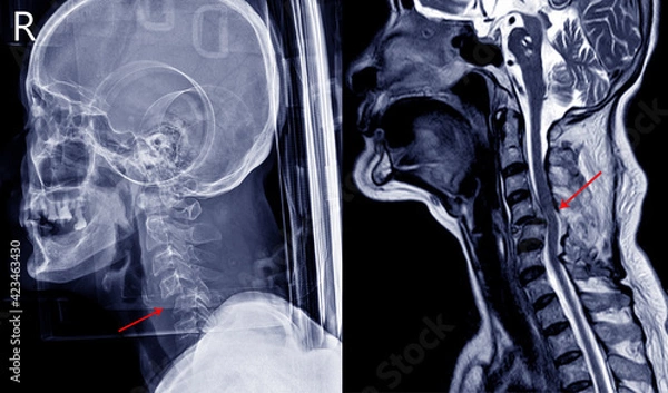 Fototapeta X-ray image and MRI of cervical spine case trauma showing joint dislocation and facet fracture. Medical concept
