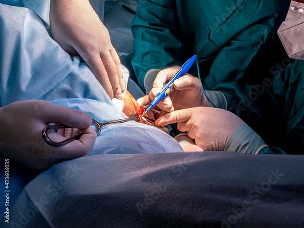 Fototapeta Selective focus on the hands of surgeons in sterile gloves working with medical instruments. Surgery on the anus to remove hemorrhoids and treat coloproctological diseases.