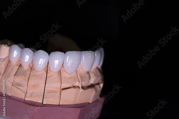 Obraz Aesthetic dentistry porcelain veneers cementation.