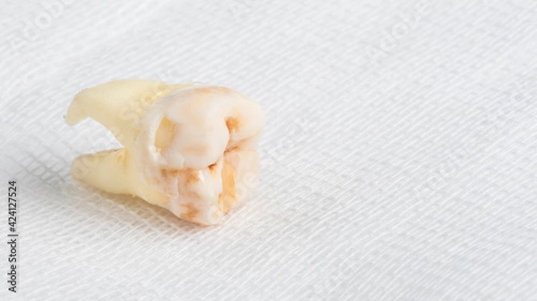 Obraz Pulled out wisdom tooth with filling and caries on white cheesecloth background. Close up of bad wisdom tooth