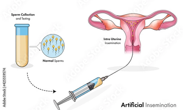 Fototapeta human anatomy: artificial insemination for women pregnancy.  