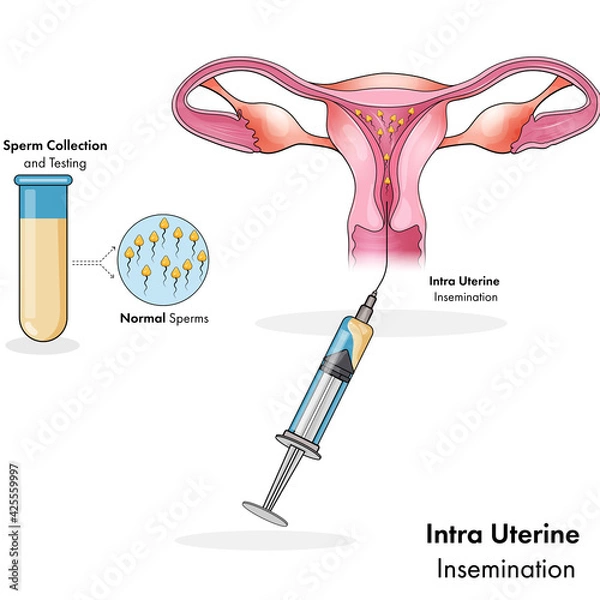 Obraz intra uterine form of artificial insemination for pregnancy vector illustration 