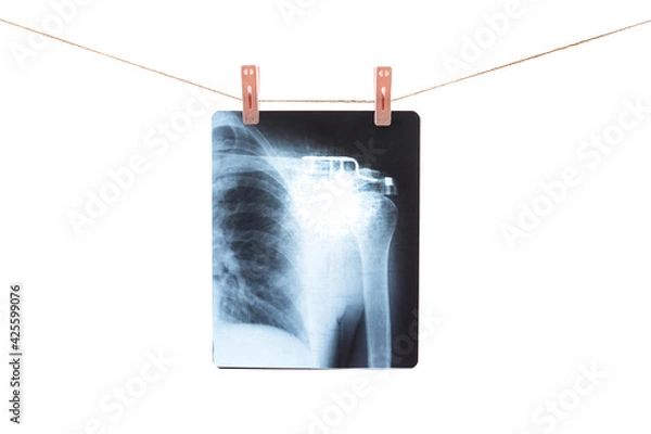Fototapeta Photo of x-ray human shoulder fixed with colorful clothespins on a rope isolated on white background.